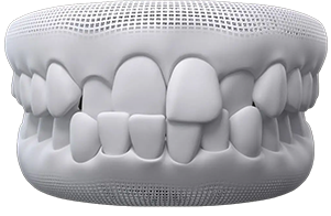 invisalign before after